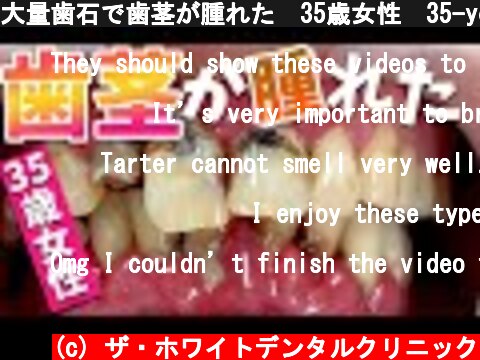(c) ザ・ホワイトデンタルクリニック 大量歯石で歯茎が腫れた🥺35歳女性🦷35-year-old woman with swollen gums /Tartar removal 大量歯石で歯茎が腫れた🥺35歳女性🦷35-year-old woman with swollen gums /Tartar removal (c) ザ・ホワイトデンタルクリニック