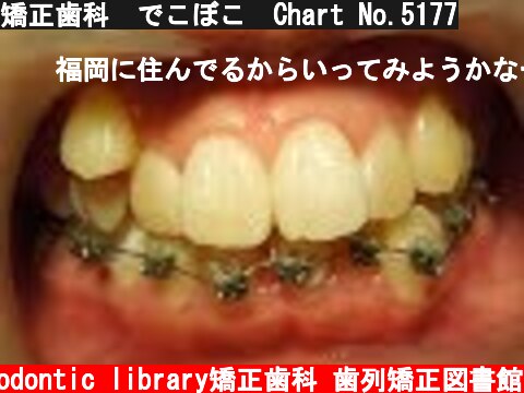 矯正歯科　でこぼこ　Chart No.5177  (c) Orthodontic library矯正歯科 歯列矯正図書館