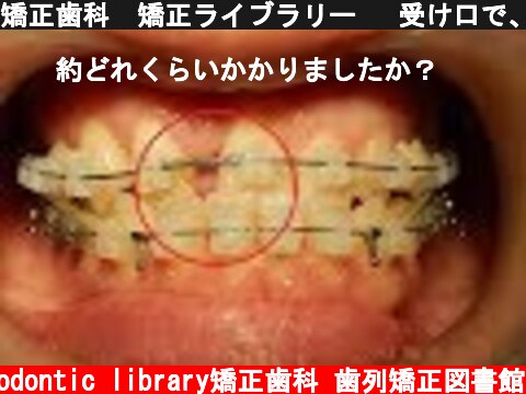 矯正歯科　矯正ライブラリー 　受け口で、上の前歯が抜けている矯正治療  (c) Orthodontic library矯正歯科 歯列矯正図書館